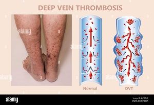Beinvenenthrombose  Symbolbild