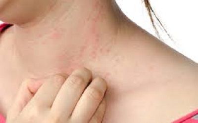 Unangenehm wenns juckt und brennt