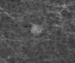Screening-detektiertes Mammakarzinom, dargestellt durch einen unscharf begrenzten Herd; Histologie: Mammakarzinom nicht spezieller Typ, Grad 2.  Copyright: @Referenzzentrum Mammographie Münster